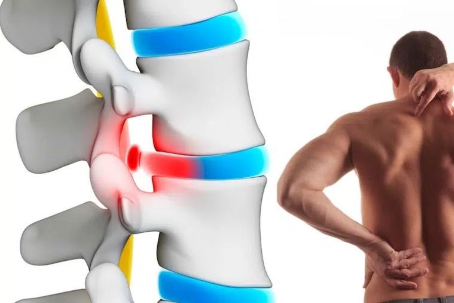 Chiropractic Care For A Bulging Disc From Coastline Chiropractic and Rehabilitation Center