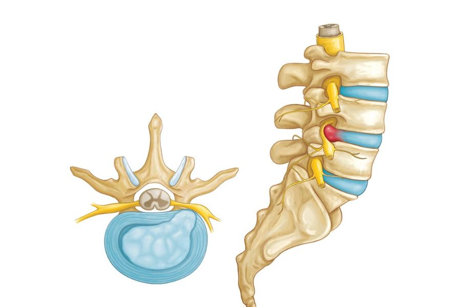 Chiropractic Care For Disc Herniation From Coastline Chiropractic and Rehabilitation Center