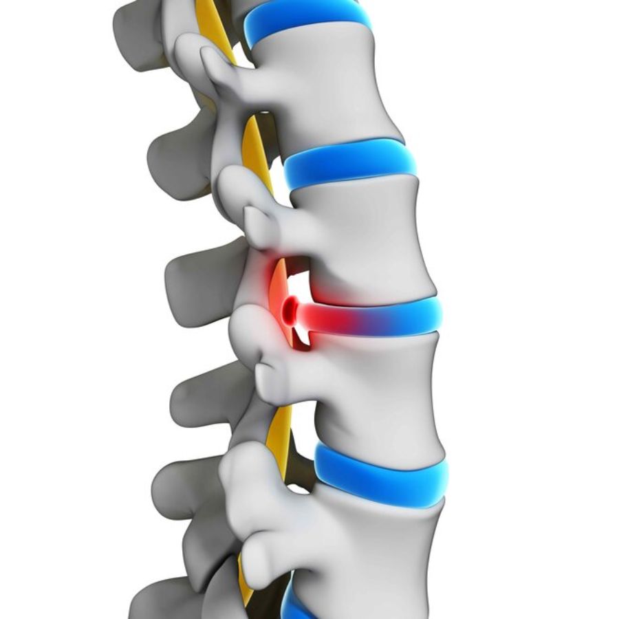 Certainly, chiropractic care plays an essential role in pain management and recovery for those suffering from a bulging disc.