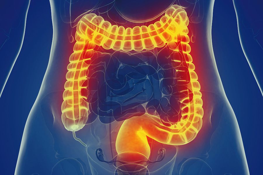 Irritable Bowel Syndrome (IBS) Coastline Chiropractic From Coastline Chiropractic and Rehabilitation Center