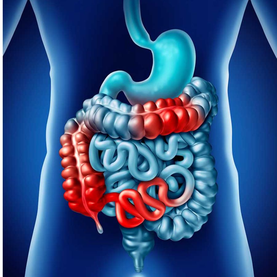 Comprehending the challenges that come with IBS, it’s natural to seek out effective approaches, and traditionally, these have largely centered around diet modifications, stress management, and medication.