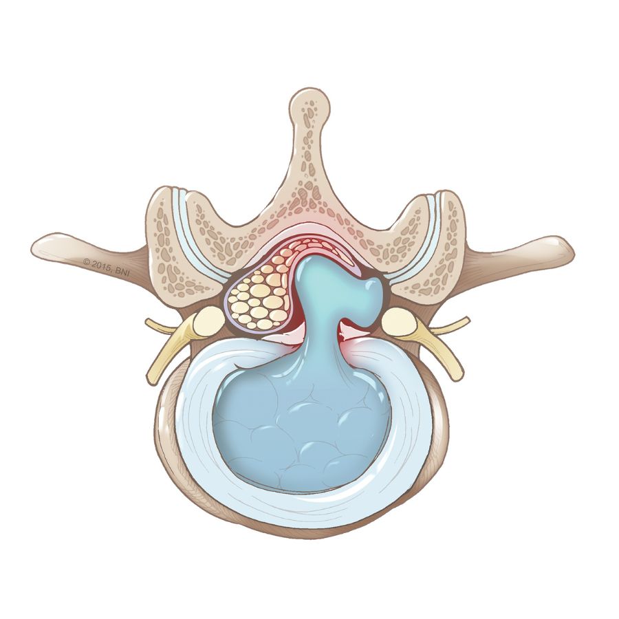 In the vast world of spinal health, one common issue we frequently encounter is a herniated disc - a condition that can cause significant discomfort and disrupt your daily activities.
